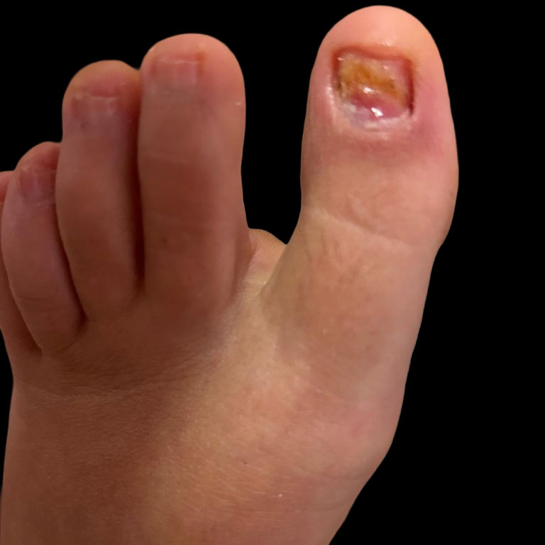 Granuloma periungueale