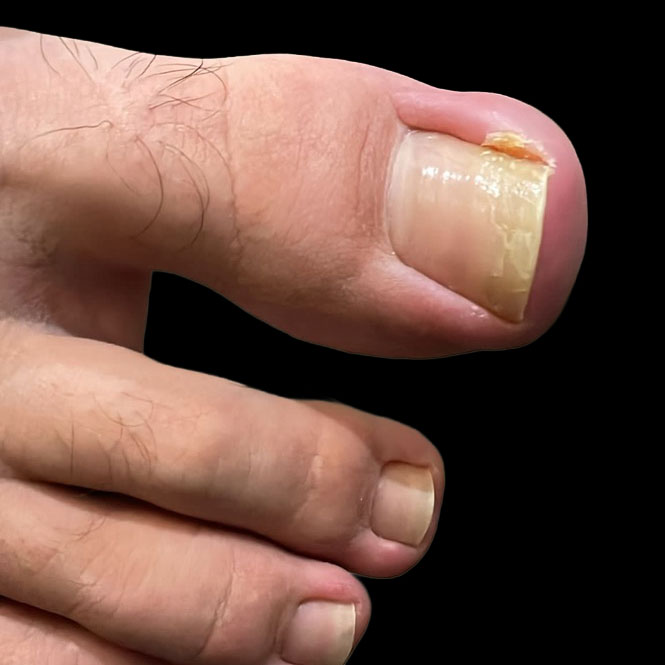 Granuloma periungueale su ascesso