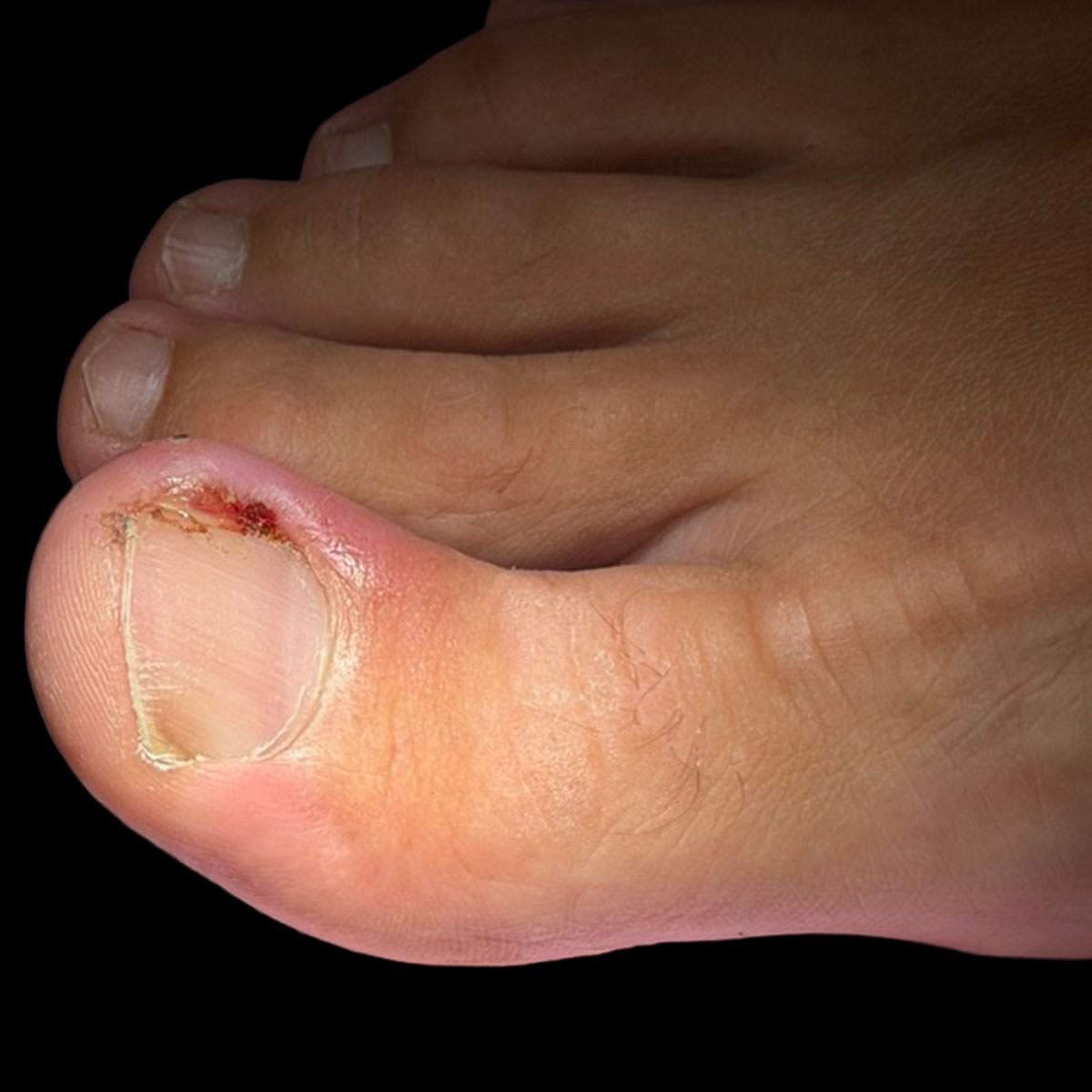Granuloma periungueale con unghia incarnita