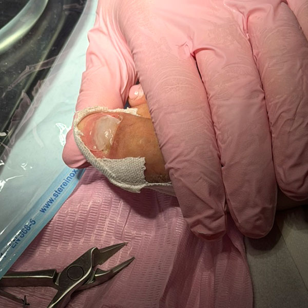 Esegui ora una ricostruzione sanitaria dell'unghia a Milano